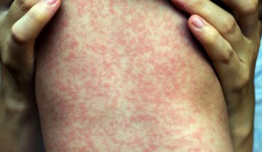 2 more Utahns diagnosed with measles, bringing state total to 5
