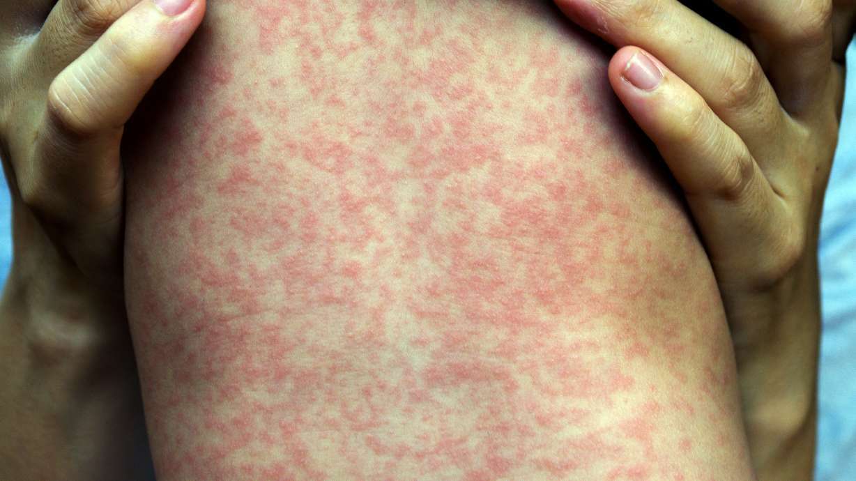 2 more Utahns diagnosed with measles, bringing state total to 5