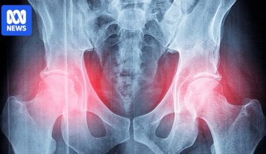 Study backing OsteoStrong 'bone-strengthening' exercise program should be retracted: experts