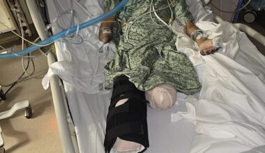 Arisbeth Munoz, 39, lost her right leg below the knee, her left leg above the knee, her right arm and her left hand due to sepsis and necrotizing fasciitis