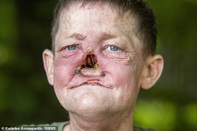 William Brogan, 47, from Hamilton, South Lanarkshire now faces major surgery to restore his face after medics were forced to amputate his nose