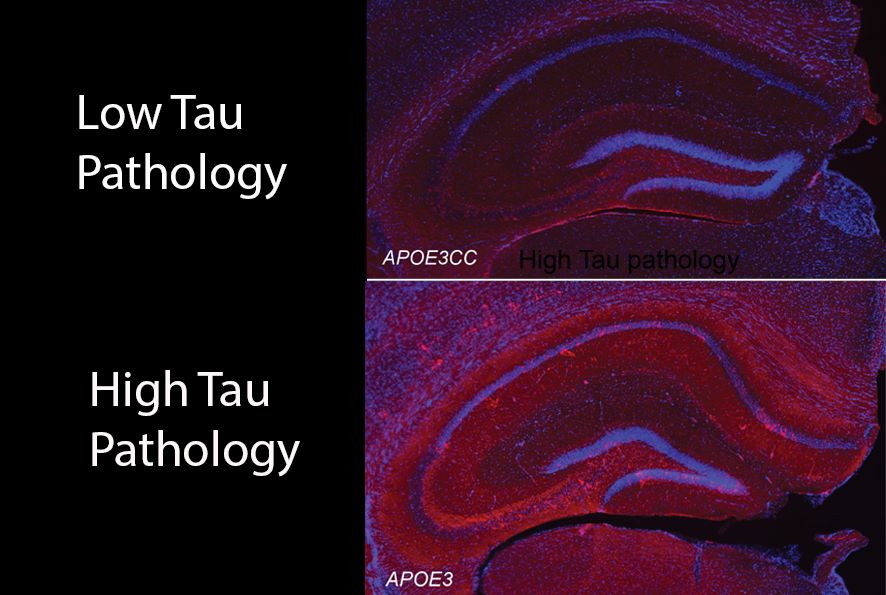 Scientists studying a Colombian family with hereditary early-onset Alzheimer’s, which typically strikes by age 50, reported that one family member, who had two copies of the Christchurch mutation, remained cognitively healthy into her 70s. Despite high brain amyloid, she exhibited low levels of tau. Subsequent research, mostly in mouse models, has confirmed the Christchurch mutation’s beneficial effects—but researchers still aren’t sure how it exerts protection. [Cornell Weill Medicine]