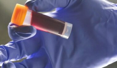 Your Blood Type Affects Your Risk of an Early Stroke, Study Finds : ScienceAlert