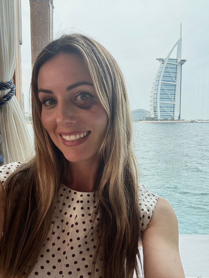Woman with a black eye in front of the Burj Al Arab.