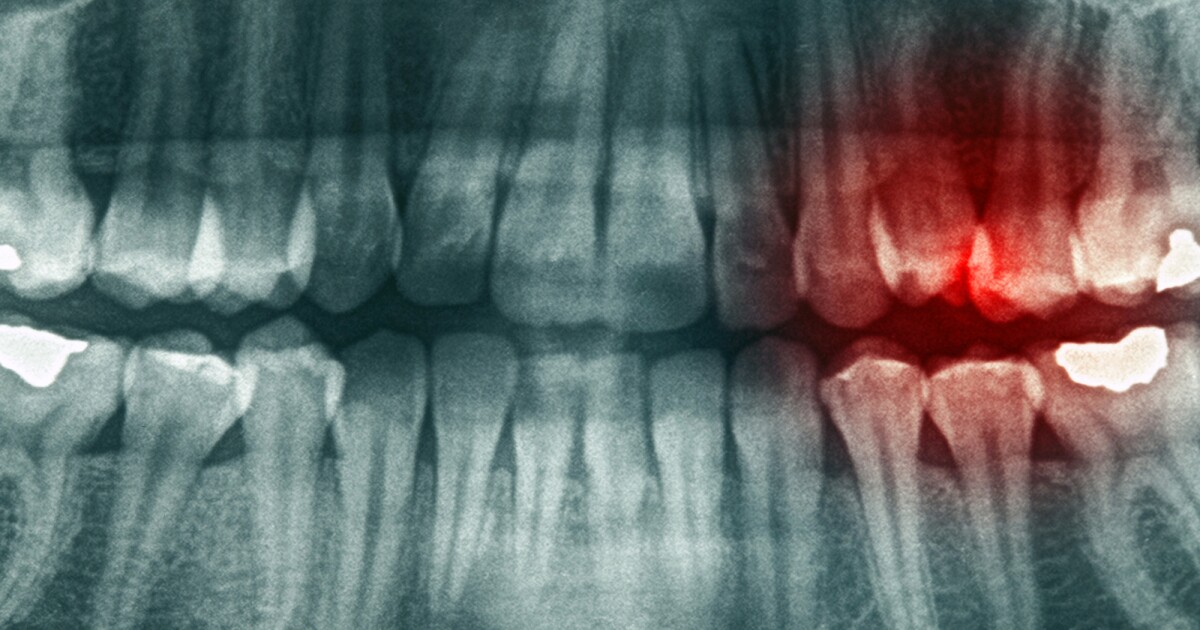 Exercise and omega-3s reduce tooth infection severity