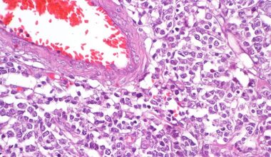 Multitasking ctDNA Helps Guide Lymphoma Treatment