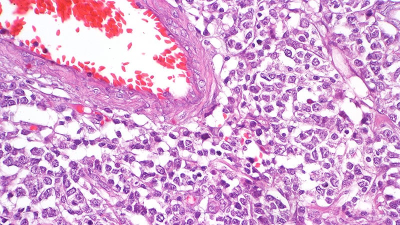 Multitasking ctDNA Helps Guide Lymphoma Treatment