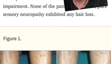 The diabetes expert warned that hair loss on the lower legs and feet can be a sign of the disease