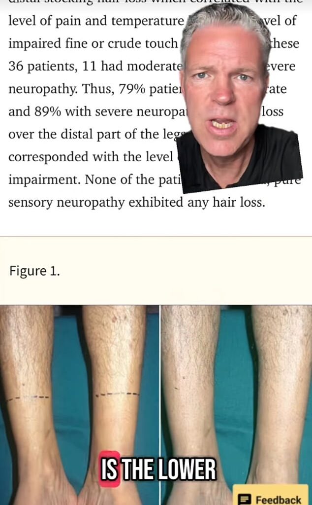 The diabetes expert warned that hair loss on the lower legs and feet can be a sign of the disease