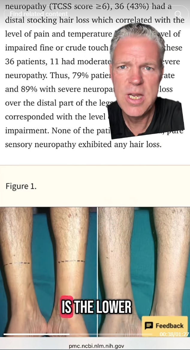 The diabetes expert warned that hair loss on the lower legs and feet can be a sign of the disease