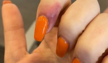 A 23-year-old woman has sued a Portland nail salon after she claims a treatment left her with a herpetic whitlow infection (pictured)