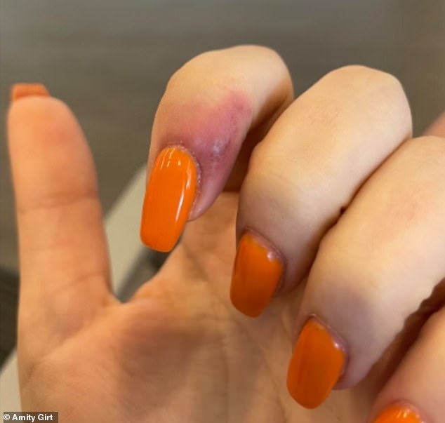 A 23-year-old woman has sued a Portland nail salon after she claims a treatment left her with a herpetic whitlow infection (pictured)