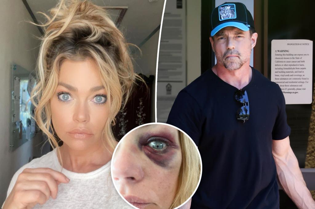 Aaron Phypers' pal claims Denise Richards' black eye was result of a drunken fall, not abuse