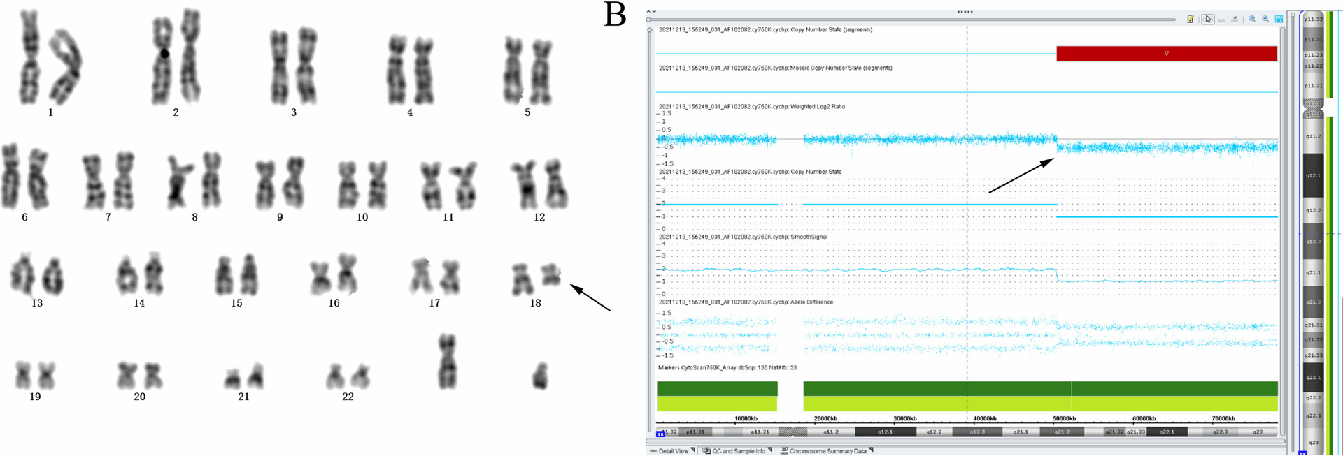 Prenatal diagnosis and genetic assessment of fetuses with single umbilical artery using chromosomal microarray analysis: a seven-year single-center retrospective study | BMC Pregnancy and Childbirth
