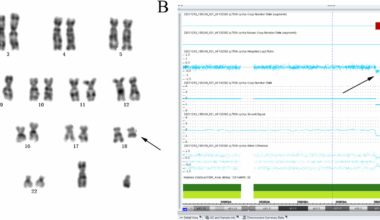 Prenatal diagnosis and genetic assessment of fetuses with single umbilical artery using chromosomal microarray analysis: a seven-year single-center retrospective study | BMC Pregnancy and Childbirth