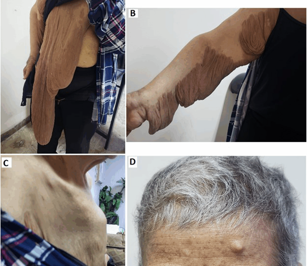 Breast carcinoma in a patient with neurofibromatosis type 1 and huge plexiform neurofibroma of the contralateral breast: a case report | BMC Women's Health