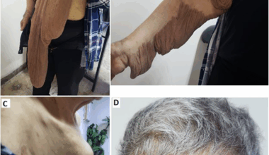 Breast carcinoma in a patient with neurofibromatosis type 1 and huge plexiform neurofibroma of the contralateral breast: a case report | BMC Women's Health