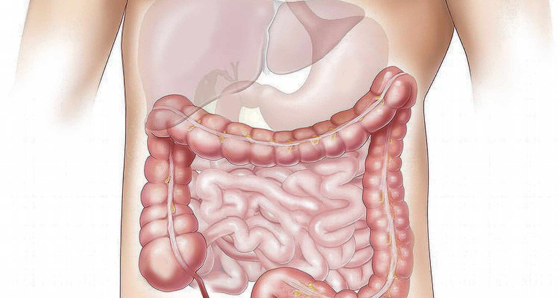 Healthy lifestyle linked to lower diverticulitis risk, irrespective of genetic susceptibility