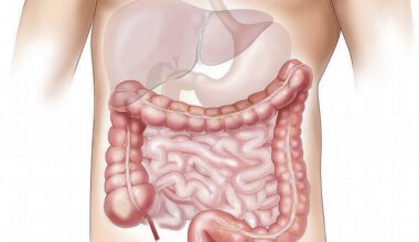Healthy lifestyle linked to lower diverticulitis risk, irrespective of genetic susceptibility