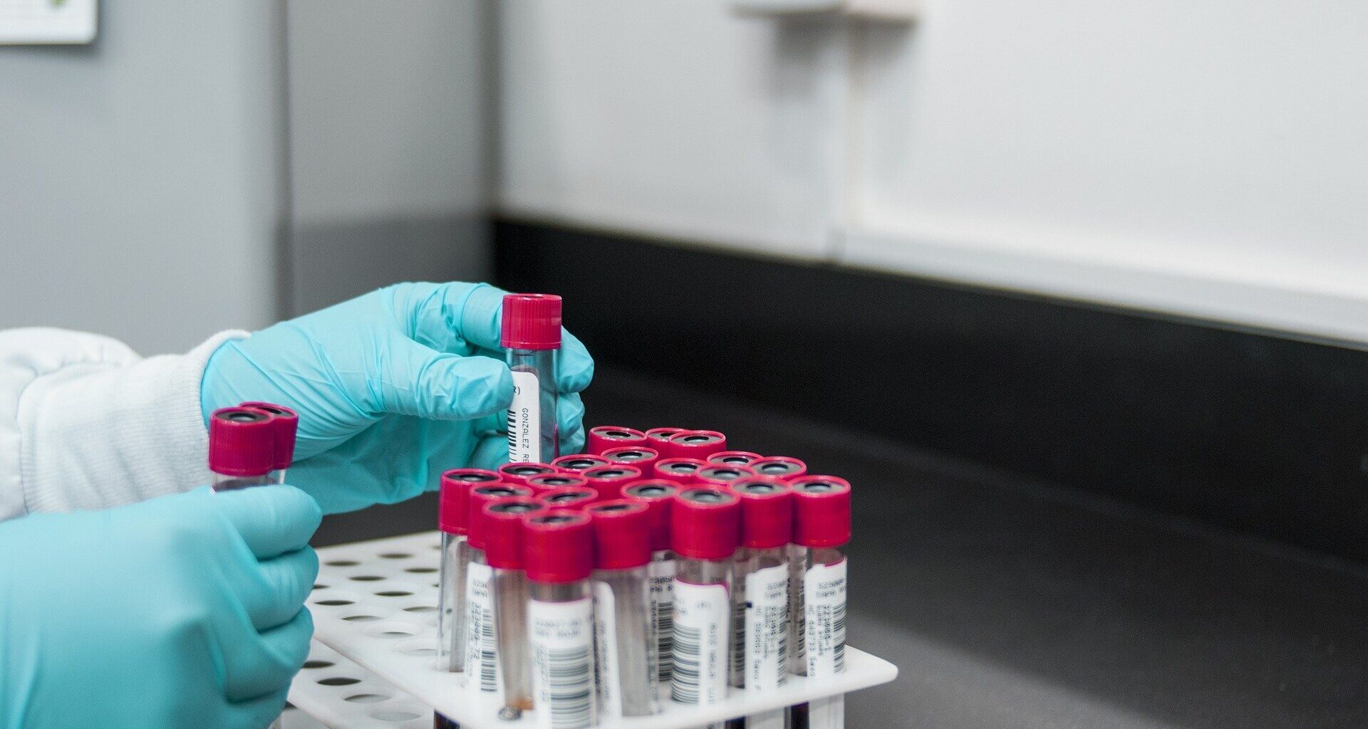 Simple blood test detects unique glycan linked to schizophrenia diagnosis