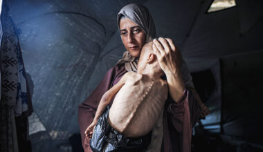 A mother holds her malnourished toddler in Gaza
