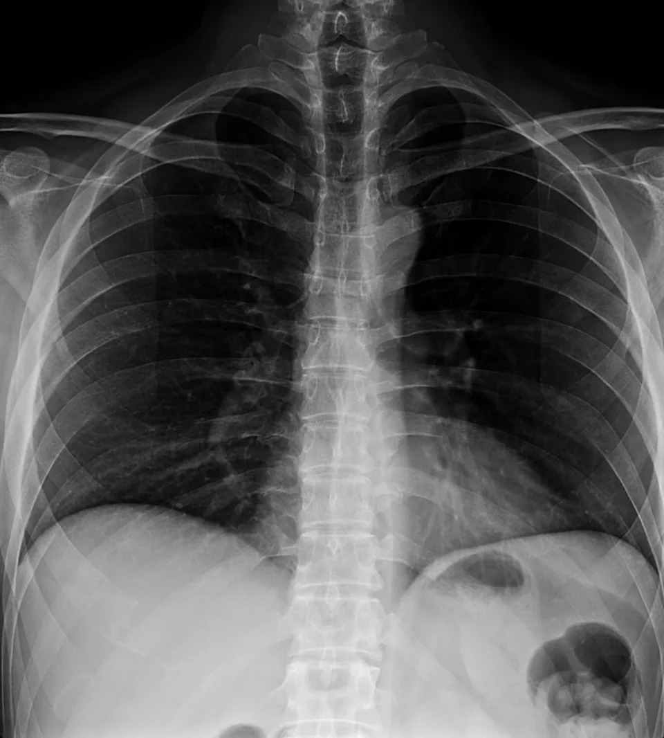 Medical chest X-ray image showing ribs, spine, and lungs
