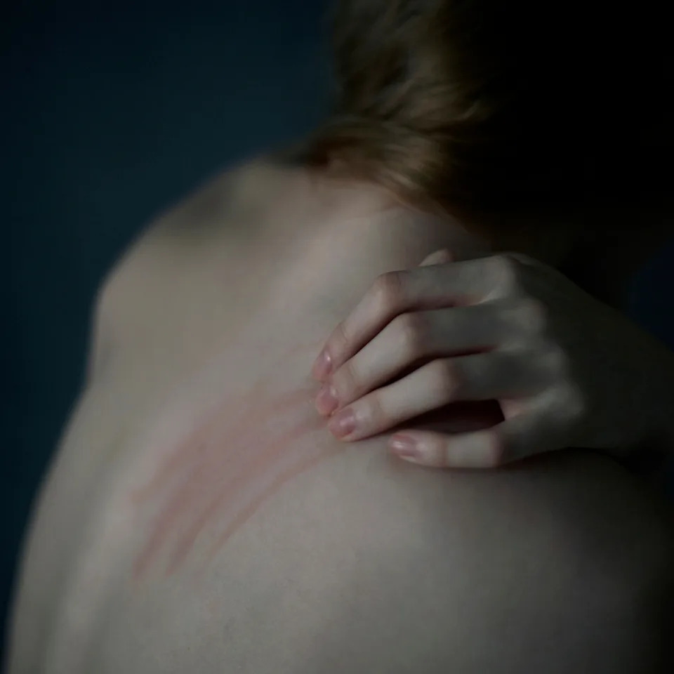 Person touching their back showing red scratch marks