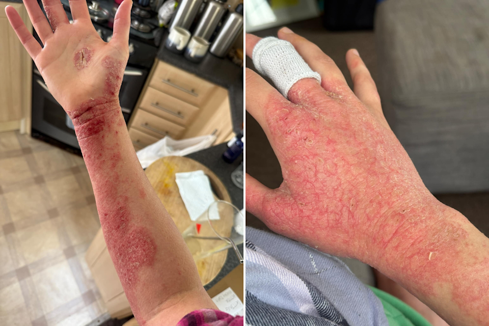 She says her skin became so painful, even clothes touching the skin would make it intolerable. (/SWNS)