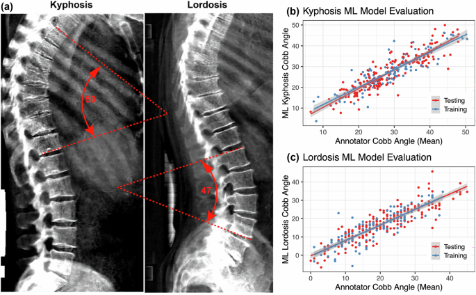 Characterizing aging-related genetic and physiological determinants of spinal curvature