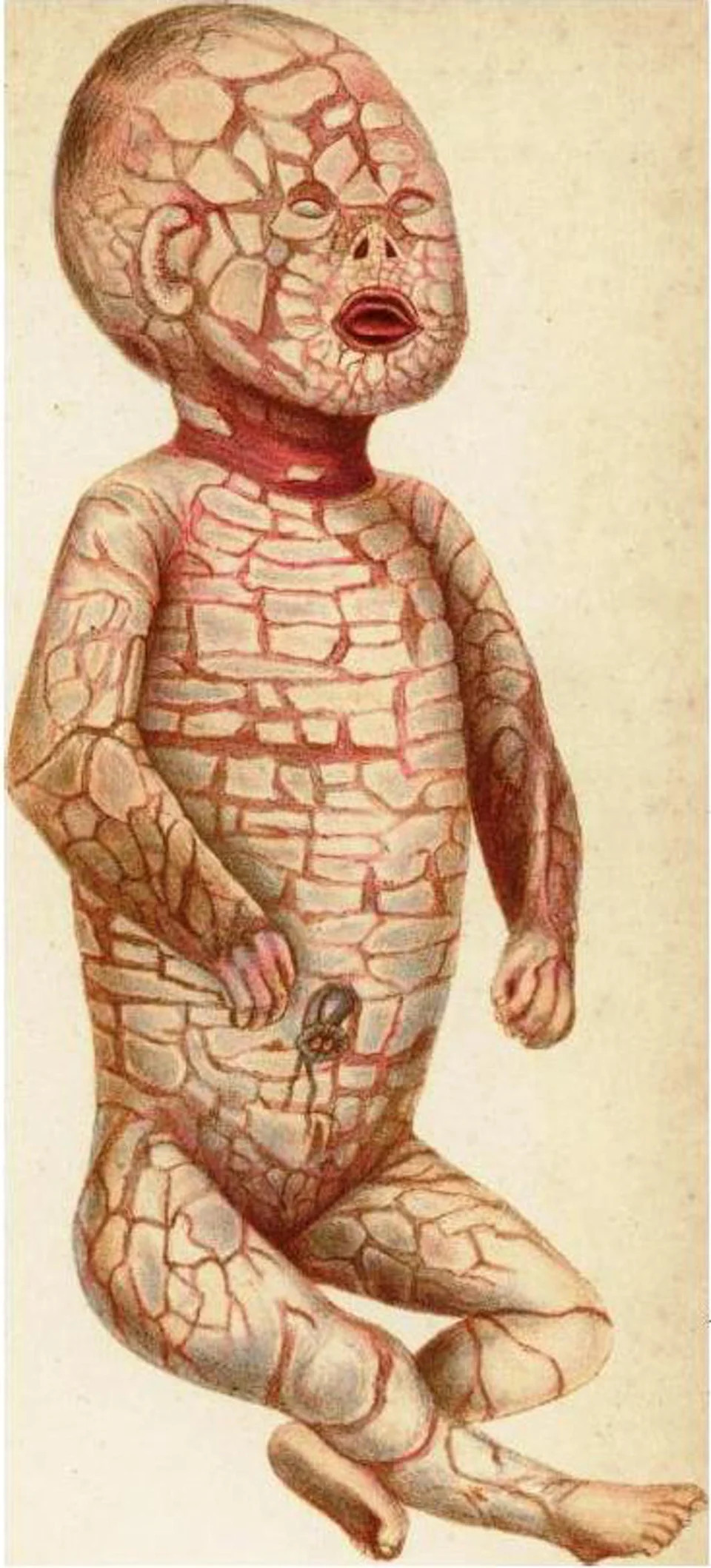 Illustration of a baby with skin resembling scales or armor, sitting with eyes and mouth open