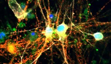 Surprise Discovery About Sugar in The Brain Could Help Fight Alzheimer's : ScienceAlert