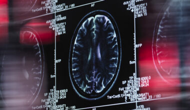 Dementia Linked With Treatment For Chronic Lower Back Pain : ScienceAlert