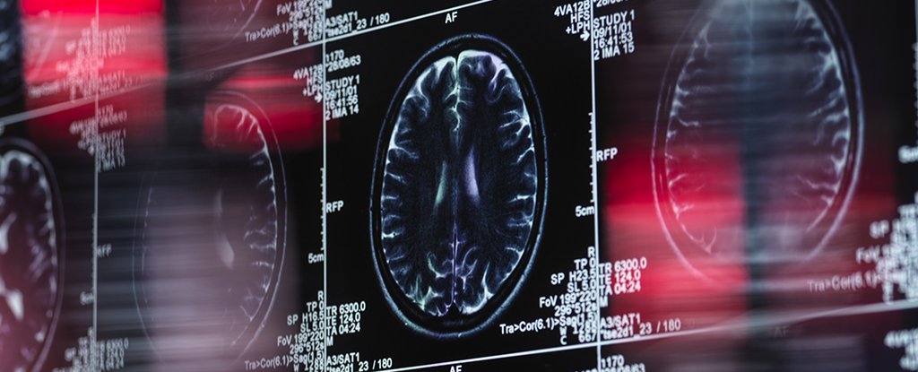 Dementia Linked With Treatment For Chronic Lower Back Pain : ScienceAlert