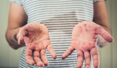The rash you should be on the lookout for as cases rise in Virginia
