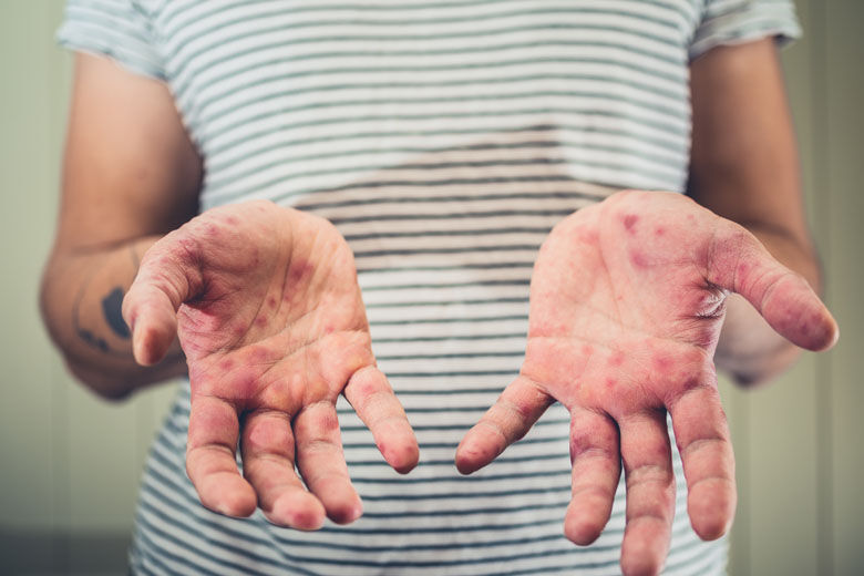 The rash you should be on the lookout for as cases rise in Virginia