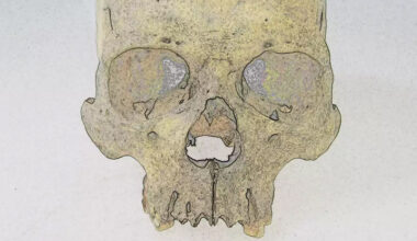 Mysterious Leprosy Pathogen Has Lurked in The Americas For 4,000 Years : ScienceAlert