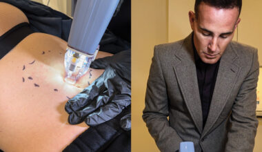 Paul Jarrod Frank treats GLP-1-related sagging with a technique known as Ellacor fractional micro- coring.