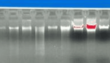 Molecular Characterization of Patatin-Like Phospholipase Domain-Containing 3 (PNPLA3) Gene in Alcoholic Liver Disease