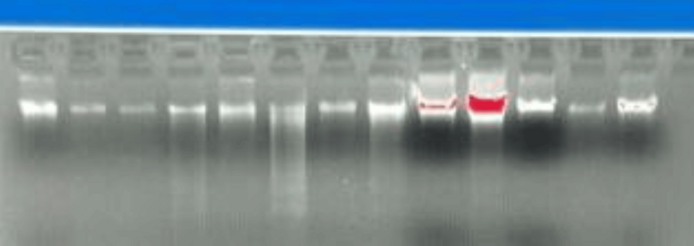 Molecular Characterization of Patatin-Like Phospholipase Domain-Containing 3 (PNPLA3) Gene in Alcoholic Liver Disease