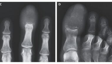 Rare Bone-Eating Cancer Replaced Man's Finger and Toe