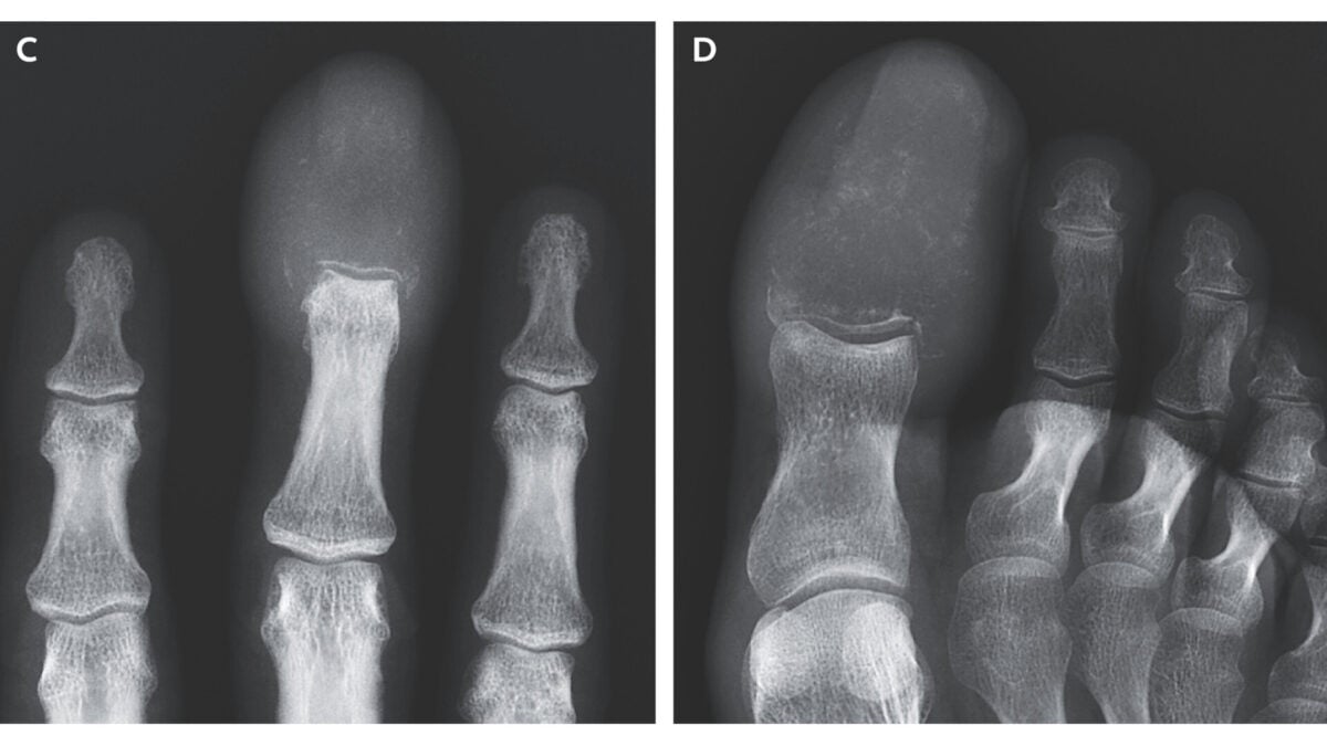 Rare Bone-Eating Cancer Replaced Man's Finger and Toe