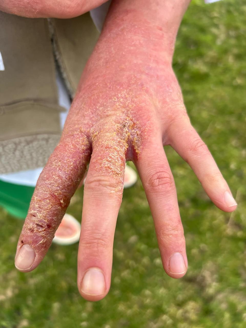 A woman who was prescribed topical steroid creams says withdrawal symptoms controlled her life and put her 