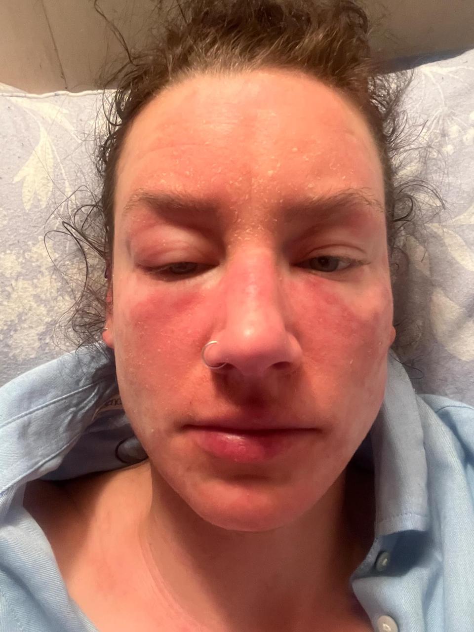 A woman who was prescribed topical steroid creams says withdrawal symptoms controlled her life and put her 