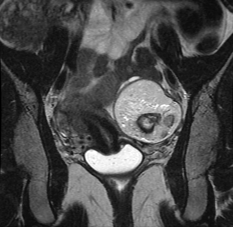 Medical MRI scan showing an abdominal cross-section with a noticeable round mass near the center