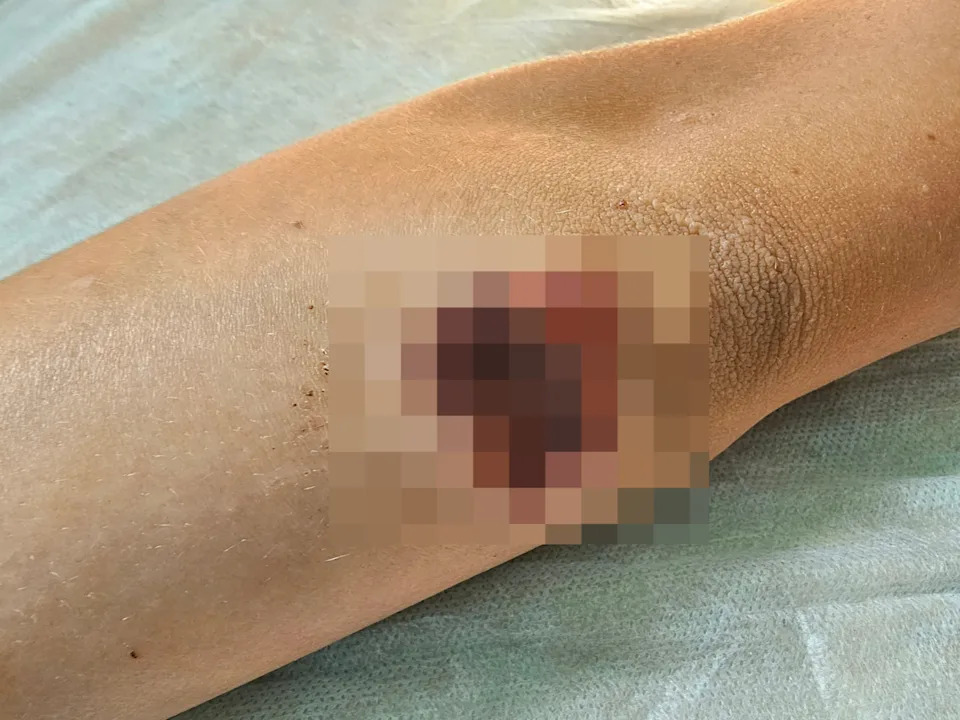 Wound on an elbow showing scabbing and redness, possibly indicating healing or irritation
