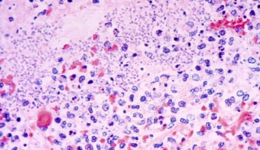 Plague kills Arizona resident, marking first recorded death since 2007, health officials say