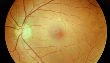 COVID Can Cause Alzheimer's-Like Plaques in Eyes And Brain : ScienceAlert