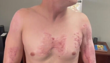 Michael Kenyon suffered third-degree burns when Phoenix officers pinned him down on hot pavement....