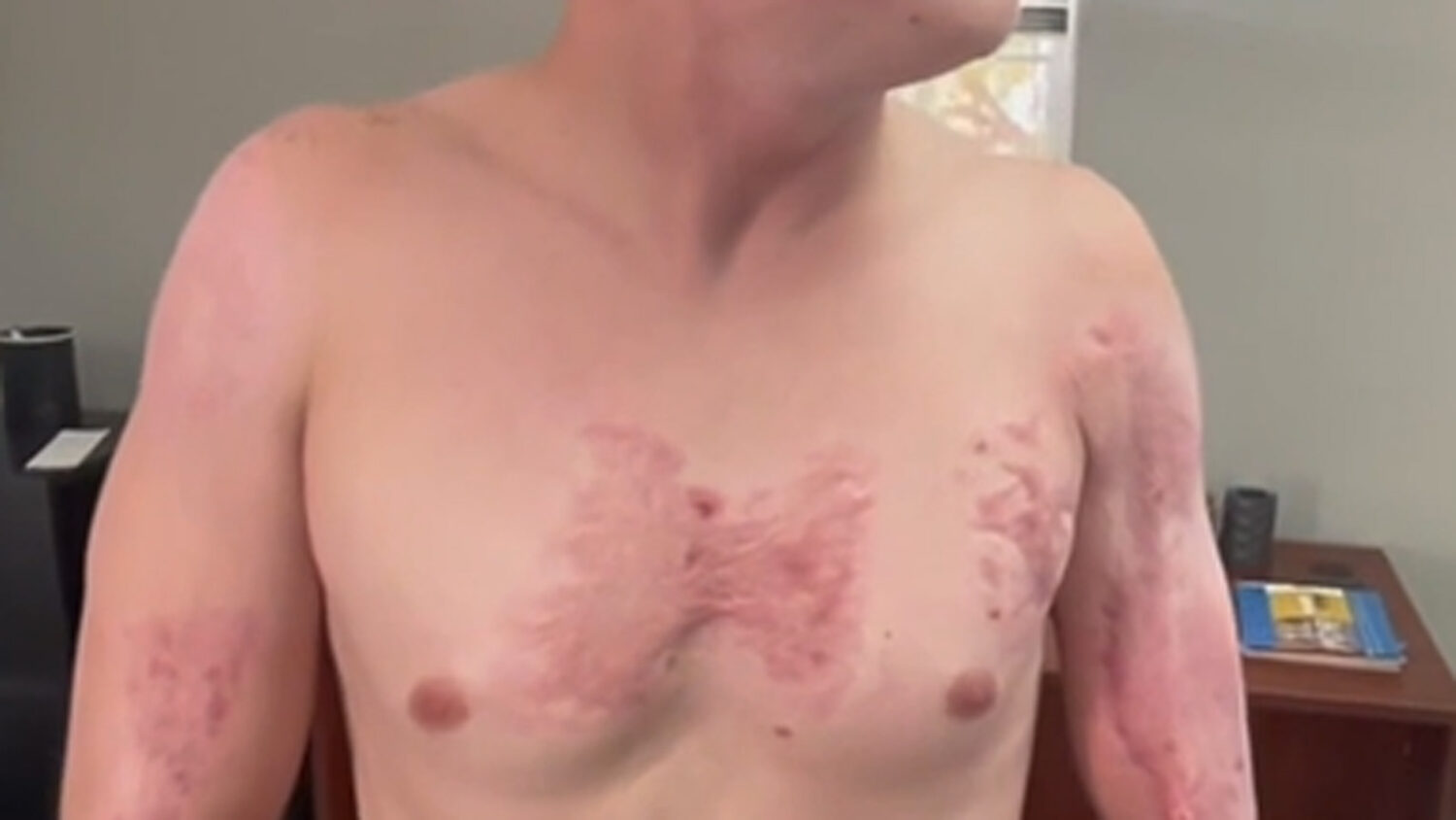 Michael Kenyon suffered third-degree burns when Phoenix officers pinned him down on hot pavement....