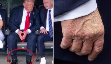 Trump suffering from chronic venous insufficiency after leg swelling: WH